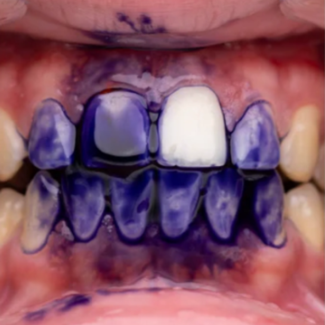 Blanqueador Dental V34