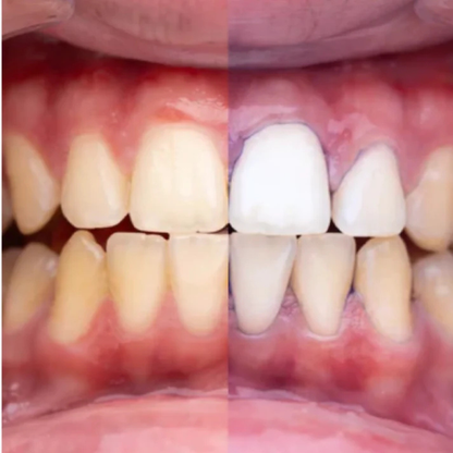 Albitor Dentar V34 GLUMI