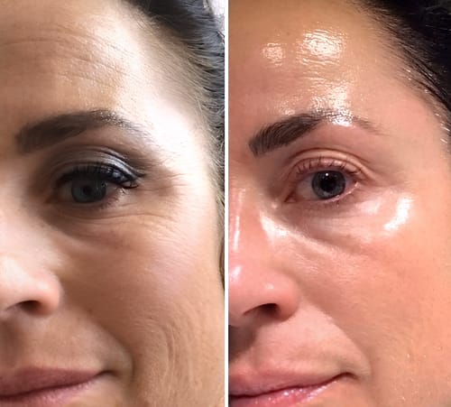Tinha a pele seca e as rugas ficavam um pouco marcadas na testa. Este creme me devolveu a hidratação. Recomendo